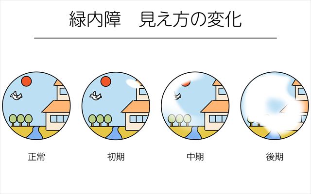 緑内障　見え方の変化
