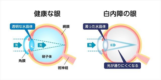 白内障